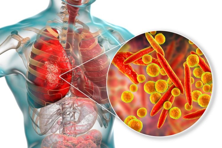 Мнозинството от смъртните случаи от COVID-19 - заради нелекувана пневмония 1 Мнозинството от смъртните случаи от COVID-19 – заради нелекувана пневмония
