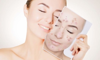 5 съвета за борба с акнето