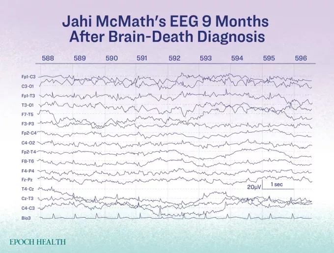 id5659887 brain death infographic 03