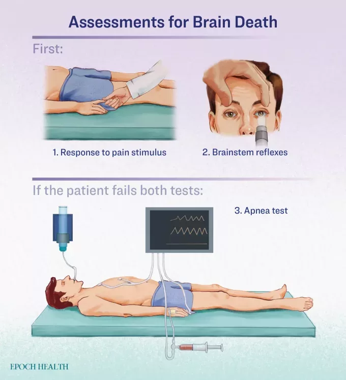 id5663342 brain death infographic