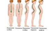 Гръбначни изкривявания при деца (https://roditel.bg/)