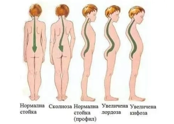 Гръбначни изкривявания при деца (https://roditel.bg/)