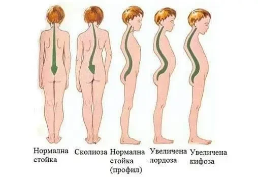 grabanchni izkrivyavania pri detsa.jpg