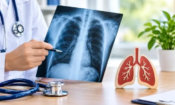Седмица за ранно откриване на туберкулозата 9 tuberculosis